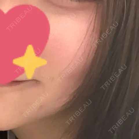 イオン導入 / 毛穴洗浄（ハイドラフェイシャルなど） 新宿Ladies&Gentlemen美容クリニック AFTER