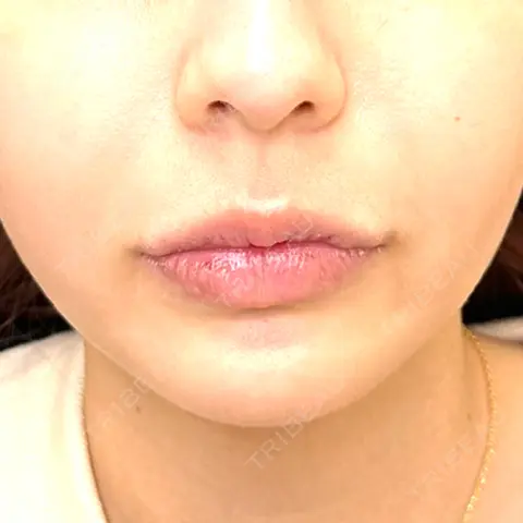ヒアルロン酸注入（あご） / ヒアルロン酸注入（唇） / ボトックス（口角） ルラ美容クリニック 名古屋栄院 AFTER
