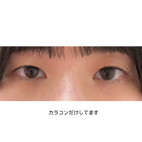 二重埋没 東京イセアクリニック AFTER