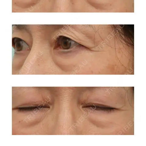 下まぶたたるみ取り WOM CLINIC GINZA （ワム クリニック ギンザ） AFTER