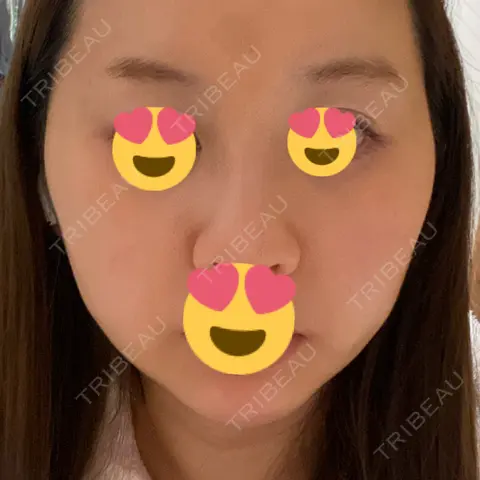 RF（高周波）たるみ治療 RIVER CLINIC（リバークリニック） AFTER
