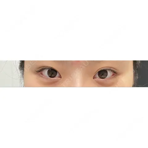 目頭切開 / タレ目形成・グラマラスライン（切開） R Beauty CLINIC 大阪院 AFTER