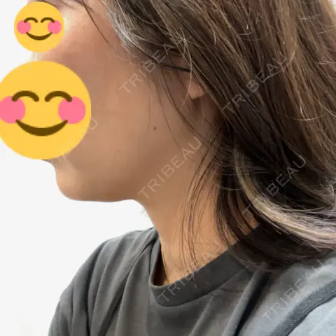 脂肪吸引（顔） PRISM Beauty Clinic AFTER