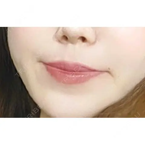 ボトックス（あご） / ヒアルロン酸注入（唇） おおたかの森ビューティークリニック AFTER