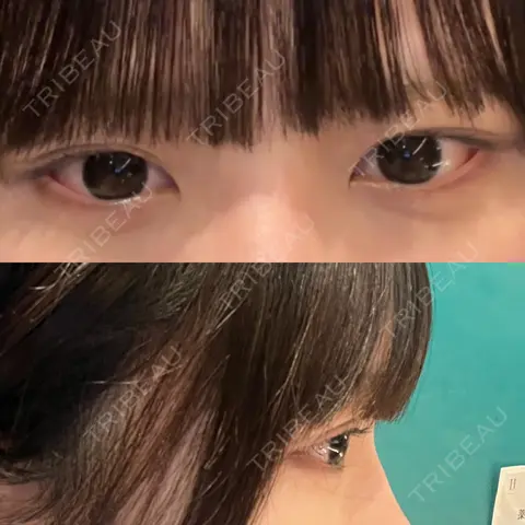 ヒアルロン酸注入（涙袋） / ヒアルロン酸注入（唇） HAAB×DREAM BEAUTY CLINIC 大阪梅田院 AFTER