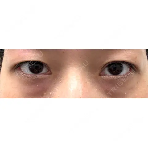 二重埋没 / クマ治療 / 下まぶたの脂肪取り / 脂肪注入（目の下） 湘南美容クリニック 西葛西院 AFTER