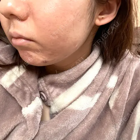 ニードルRF（ポテンツァなど） / ポテンツァ / その他（肌） ゆきスキンクリニック 東池袋 AFTER