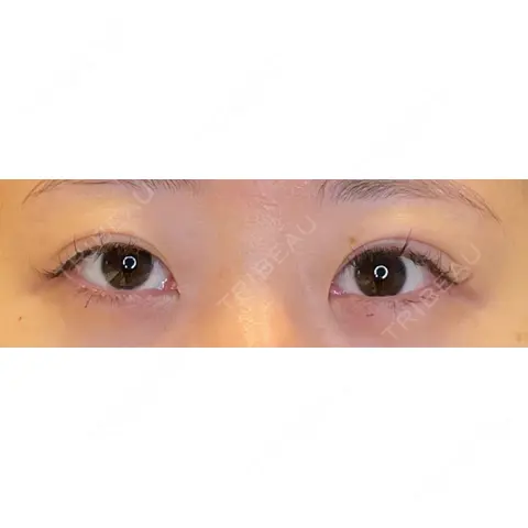 目尻切開 / タレ目形成・グラマラスライン（埋没） / 美容点滴・美容注射（美肌） LOUIS CLINIC 二子玉川院【ルイクリニック】 AFTER