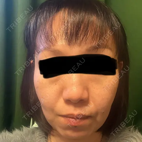 糸リフト / クマ治療 / 下まぶたの脂肪取り / 脂肪注入（肌） / こめかみ形成 / 脂肪注入（目の下） / ボトックス（あご） / ボトックス（首） 東京シンデレラ美容外科 池袋院 AFTER