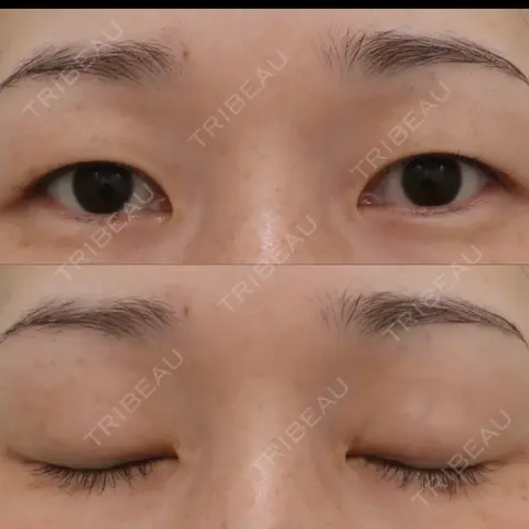 二重埋没 WOM CLINIC GINZA （ワム クリニック ギンザ） AFTER
