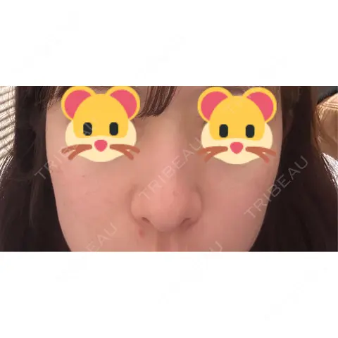 軟骨移植 / 目元修正 / 自然癒着法 / 鼻尖形成（非切開） eクリニック 福岡院 AFTER