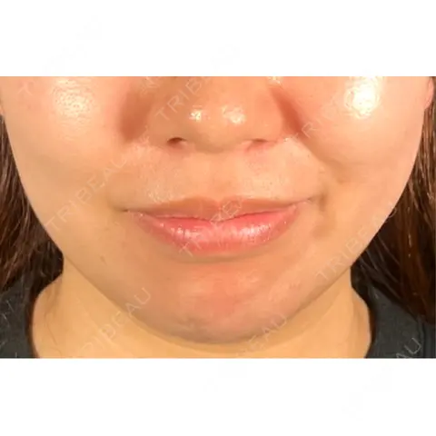 脂肪吸引（顔） R Beauty CLINIC 大阪院 AFTER