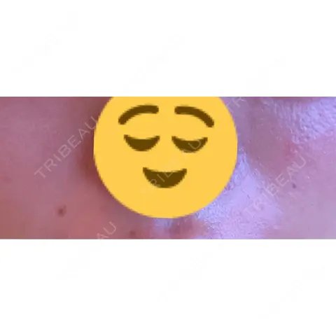 肌ヒアルロン酸注入（たるみ・シワ改善） / ボトックス（口角） / ヒアルロン酸注入（首） LUVO CLINIC TOKYO AFTER