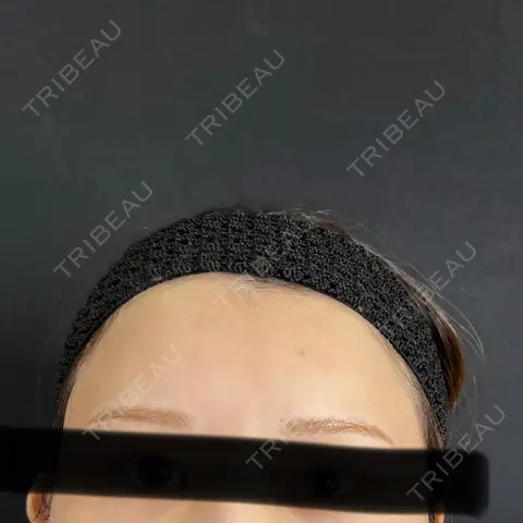 ヒアルロン酸注入（額） 藤・ナチュレ美容クリニック 銀座院 AFTER
