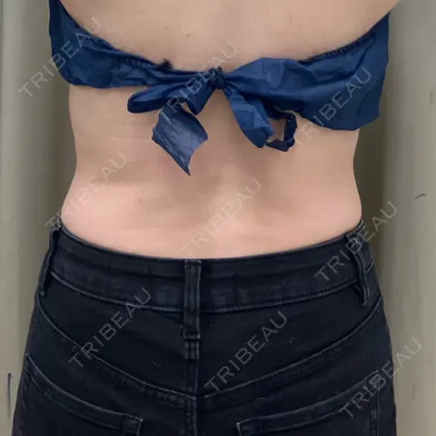 脂肪冷却（背中・ブラファット） DMTC美容皮膚科 日本橋院 AFTER