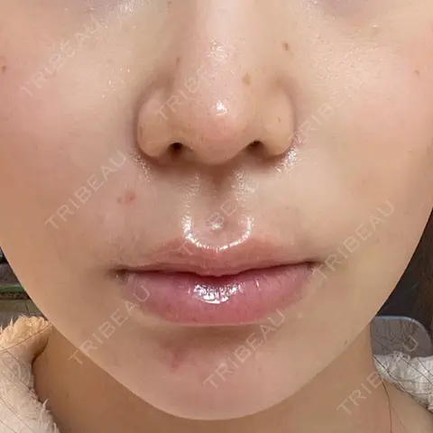 人中短縮 聖心美容クリニック 六本木院 AFTER