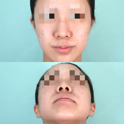 鼻尖形成（切開） / 鼻中隔延長（切開） / 小鼻縮小（切開） / 軟骨移植 / 骨切幅寄せ / ワシ鼻修正・ハンプ切除 / 鼻翼基部形成（貴族手術） / 鼻柱下降・鼻唇角形成（猫手術） / その他（鼻） WOM CLINIC GINZA （ワム クリニック ギンザ） AFTER