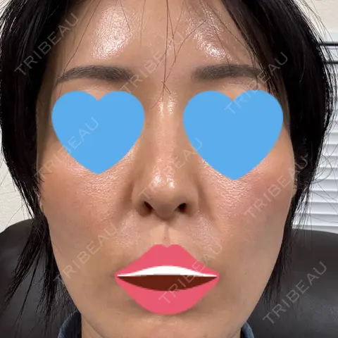 水光注射（ハリ・美肌） / 肌育注射（ジュベルックなど） DAILY SKIN CLINIC 新宿院 AFTER