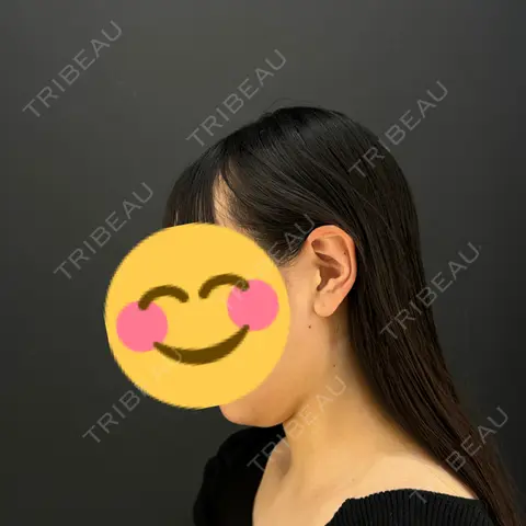 二重埋没 / 糸リフト / 脂肪吸引（顔） HAAB×DREAM BEAUTY CLINIC 東京本院 AFTER
