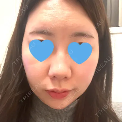 ヒアルロン酸注入（こめかみ） DMTC美容皮膚科 渋谷院 AFTER