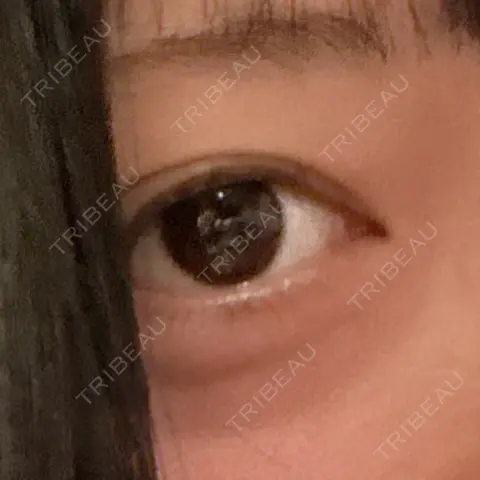 下まぶたたるみ取り / 下まぶたの脂肪取り 東京シンデレラ美容外科 池袋院 AFTER