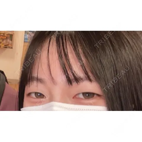 二重埋没 / 目頭切開 HAAB BEAUTY CLINIC 名古屋院 AFTER