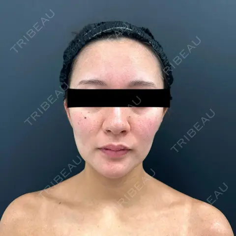 糸リフト BLINC CLINIC （ブリンク クリニック） AFTER