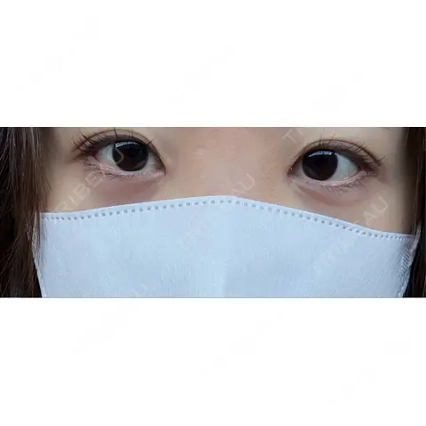 ヒアルロン酸注入（涙袋） AI Beauty Clinic （エーアイ美容クリニック） AFTER