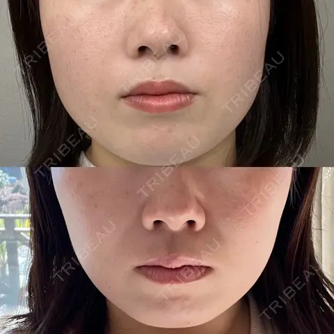 糸リフト / 脂肪吸引（顔） THE FIRST CLINIC 多摩センター院 AFTER