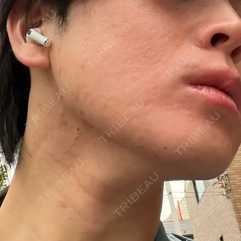 ダーマペン ゆきスキンクリニック 東池袋 AFTER