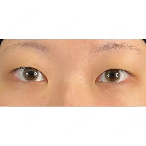 二重埋没 / 上まぶたの脂肪取り 藤・ナチュレ美容クリニック 銀座院 AFTER