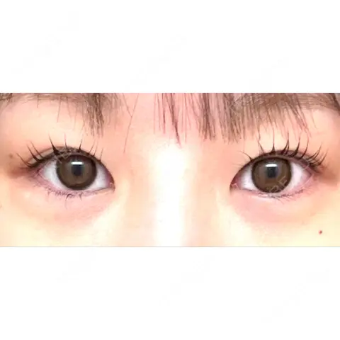 二重埋没 湘南美容クリニック 池袋東口院 AFTER