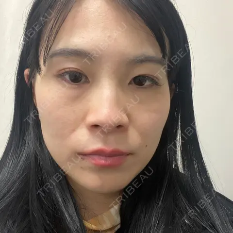 水光注射（ハリ・美肌） / イオン導入 しんゆり美容健康クリニック AFTER
