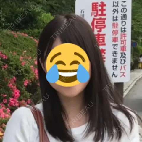 脂肪吸引（顔） / 輪郭修正 / その他（輪郭） リラ・クラニオフェイシャル・クリニック AFTER