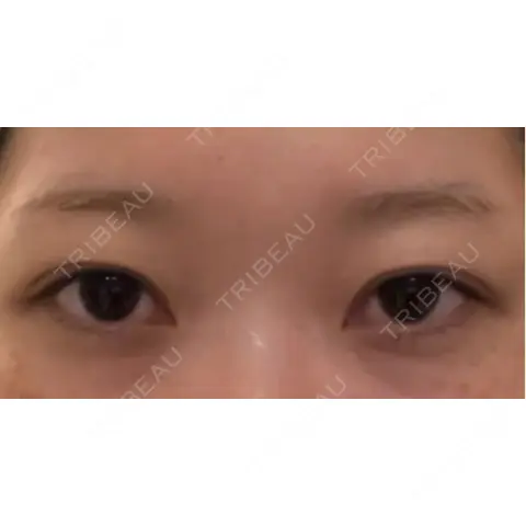 二重埋没 / 自然癒着法 Brandnew Beauty Clinic AFTER
