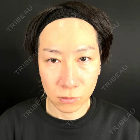 二重埋没 / クマ治療 / 脂肪注入（目の下） 藤・ナチュレ美容クリニック 銀座院 AFTER