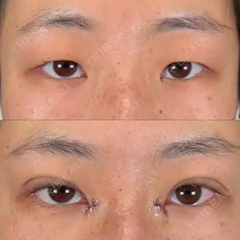 二重埋没 / 目頭切開 湘南美容クリニック 西葛西院 AFTER