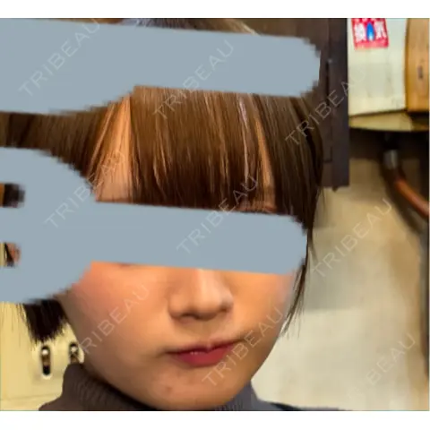 ボトックス（口角） / ヒアルロン酸注入（鼻翼基部） BiBiクリニック AFTER