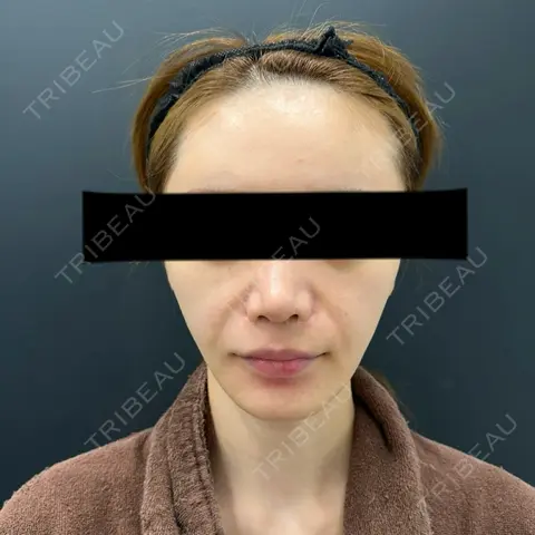 脂肪吸引（顔） BLINC CLINIC （ブリンク クリニック） AFTER