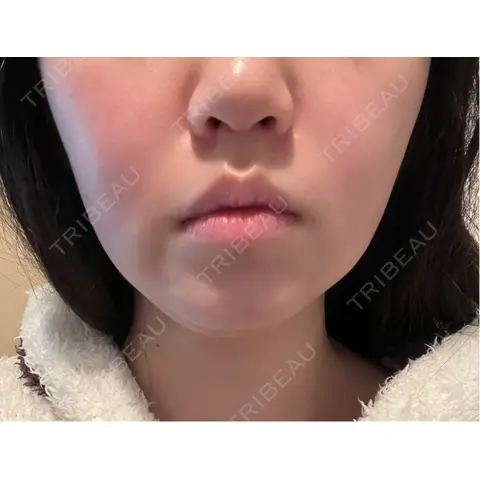 光治療（フォトフェイシャルなど） 大美会クリニック 梅田院 AFTER