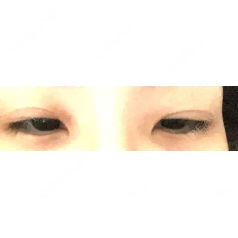 二重埋没 / 目頭切開 HAAB×DREAM BEAUTY CLINIC 東京本院 AFTER