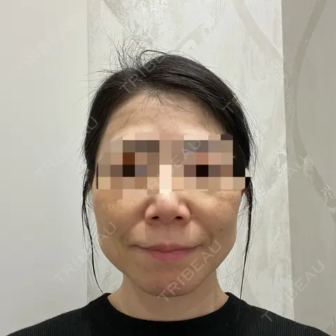 ヒアルロン酸注入（頬） TCB東京中央美容外科 京都四条院 AFTER