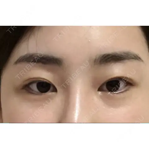 二重埋没 / 眼瞼下垂（切開） / 目尻切開 / 蒙古ひだ形成 / タレ目形成・グラマラスライン（切開） POP美容整形クリニック AFTER