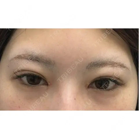 ヒアルロン酸注入（涙袋） / ヒアルロン酸注入（唇） NARU Beauty Clinic 【ナルクリ】 水戸院 AFTER