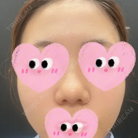 鼻尖形成（切開） / 軟骨移植 / 鼻柱下降・鼻唇角形成（猫手術） 東京シンデレラ美容外科 新宿院 AFTER