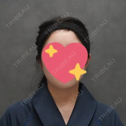 糸リフト / 脂肪吸引（顔） / 脂肪吸引（二の腕） / ヒアルロン酸注入（あご） / ボトックス（エラ・小顔） ヴェルトラクリニック 大阪院 AFTER
