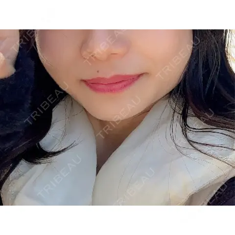 ボトックス（エラ・小顔） TCB東京中央美容外科 中野院 AFTER