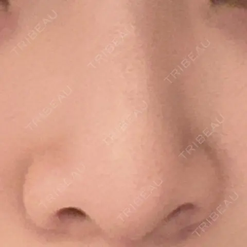鼻尖形成（切開） / 軟骨移植 RIVER CLINIC（リバークリニック） AFTER