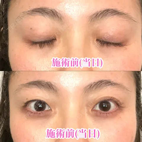 眼瞼下垂（切開） 形成外科と美容外科のクリニック池袋 AFTER