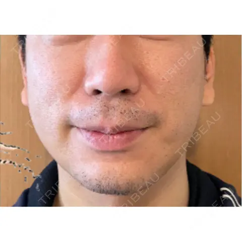 糸リフト / バッカルファット除去 / 脂肪吸引（顔） BLINC CLINIC （ブリンク クリニック） AFTER